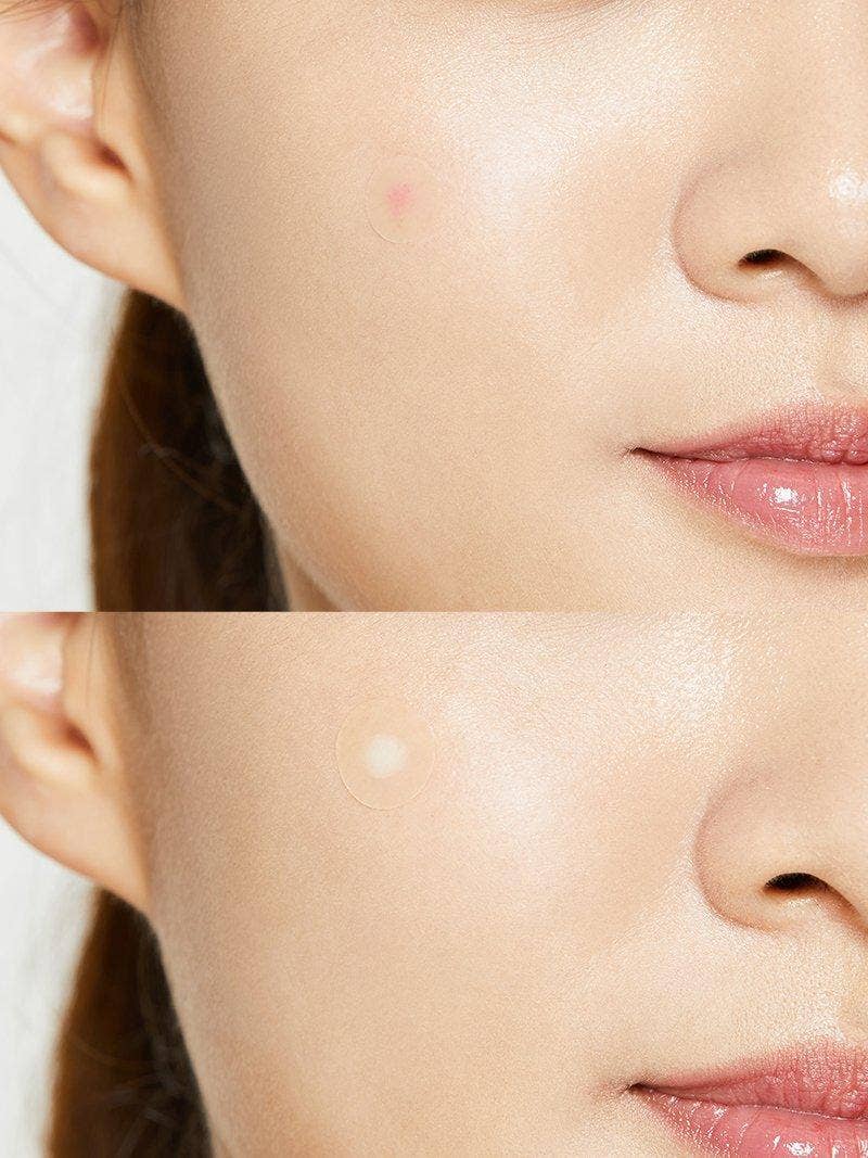 Patchs Anti-Boutons Coréens – Élimine les Imperfections en Une Nuit (24 Patchs Invisibles)